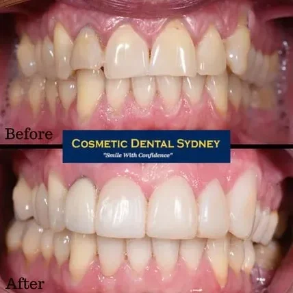 Smile Makeover 1