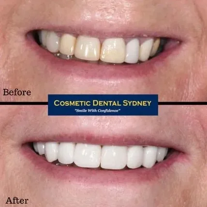 Smile Makeover 2