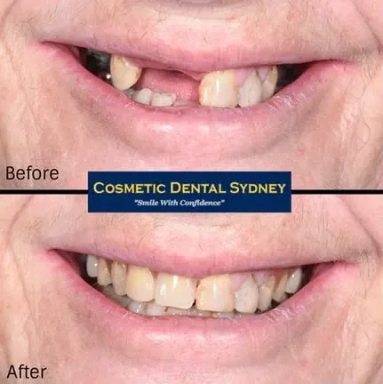 Smile Makeover 4