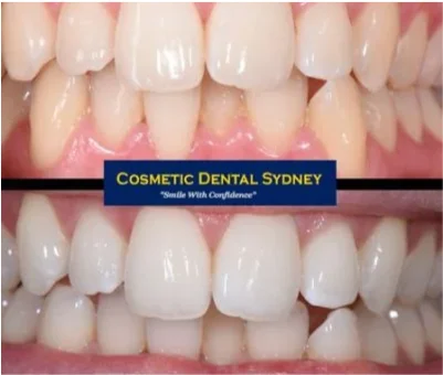 Smile Makeover 5