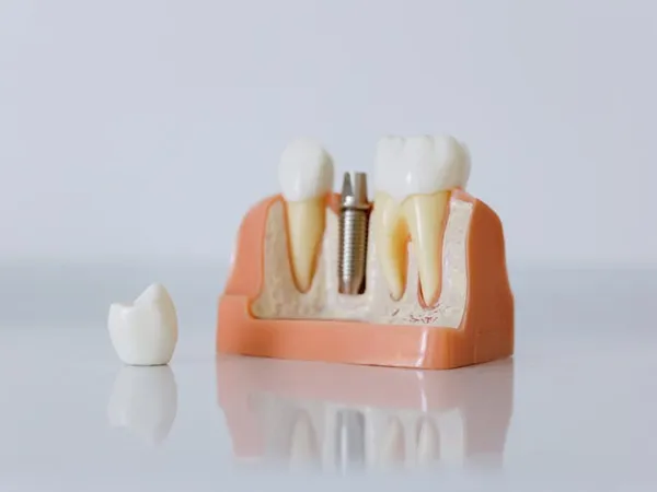 Implants