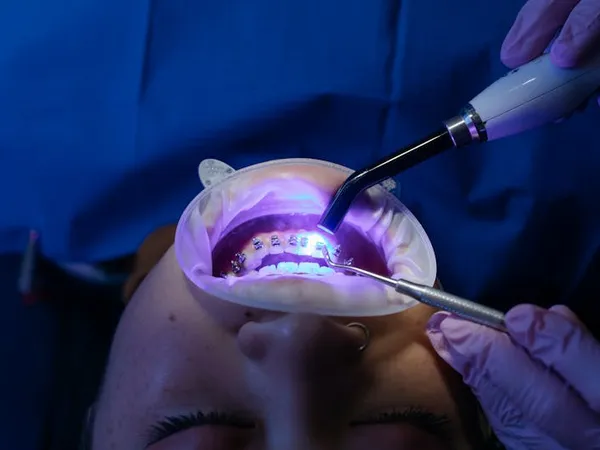 Root Canals